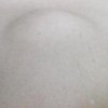 你是否了解脂肪瘤的危害呢