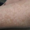 预防花斑癣的措施有哪些