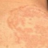 关注花斑癣治疗的手法