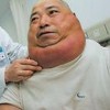 皮下脂肪瘤对人体有什么危害