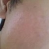 如何治疗花斑癣