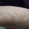 花斑癣的治疗办法有什么