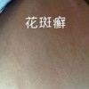 药物微波渗透疗法治花斑癣