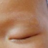 你知道花斑癣治疗的较好方法