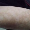 青岛如何治疗花斑癣
