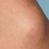 关于形成乳腺脂肪瘤的病因有什么