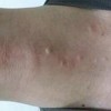 你知道乳腺脂肪瘤的病因吗