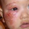 儿童脓疱疮的预防措施是什么