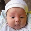 青岛如何治疗新生儿脓疱疮