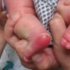 掌趾脓疱疮的病因和治疗