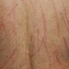 怎样护理儿童皮肤瘙痒患者