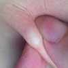 容易与颅内脂肪瘤混淆的疾病