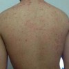 秋季皮肤瘙痒患者有什么不能吃呢