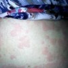 皮肤瘙痒会症状有什么