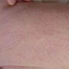 皮肤瘙痒防治的几个要点