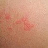 皮肤瘙痒的致病因素到底包含什么呢