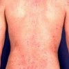 皮肤瘙痒症变得更加严重的原因