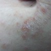 引起皮肤瘙痒症的两种病因