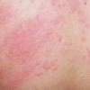 怎么避免皮肤瘙痒带来的危害