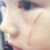 去疤痕主要受到哪些因素影响