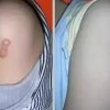 疤痕为什么会增生