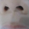 为什么会长疤痕疙瘩呢