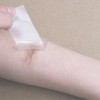 怎样预防伤口留下疤痕呢