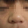 九大预防措施让你远离雀斑