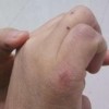 冻疮应怎样治疗呢和预防呢
