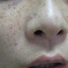 黄褐斑患者治疗中应该小心哪些