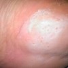 治疗脚气可以补充维生素B1