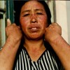 什么是皮肌炎症状有什么