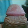 性病性淋病肉芽肿有什么表现