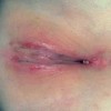 男性淋病的主要症状是哪些