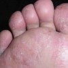 脚上长很痒的水泡是脚气不