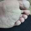 脚部干裂脱皮和脚气有关系吗