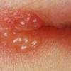 原发性疱疹性口炎症状是什么