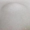 脂肪瘤是如何引起的