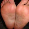脚气的症状表现有什么