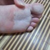 脚气的致病因素都是什么呢