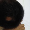患有斑秃可以自愈吗