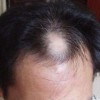 斑秃早期如何治疗呢