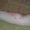 那么脂肪软纤维瘤有哪些特点