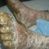 hiv与艾滋病的区别