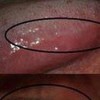 艾滋病常见哪些症状