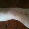 艾滋病窗口期无症状
