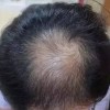 儿童斑秃能治愈吗