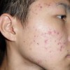 痤疮的最佳治疗的手法
