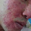 痤疮粉刺如何治疗