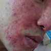 痤疮能治吗